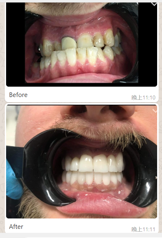Dental Lab case | Beautiful Restoration with 3D Zirconia